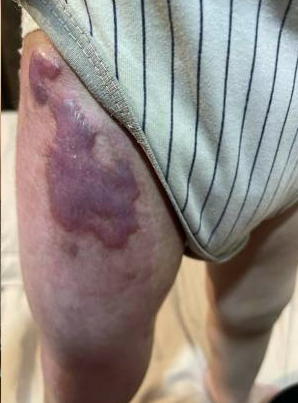 成都惠好安康烧伤康复故事：被温柔抚平的伤痕：2岁宝宝大腿烫伤的康复奇迹