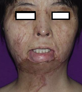 成都惠好安康烧伤康复故事：两次手术的教训：一位面部烧伤求美者的康复觉醒之路