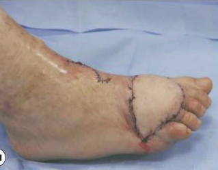 成都惠好安康烧伤康复故事：被烫伤的舞步：一位茶馆老板娘的双重救赎