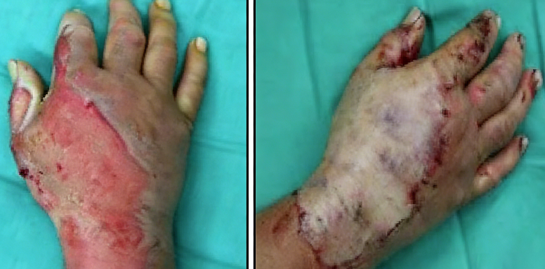 成都惠好安康烧伤康复故事：黄金72小时：一位川菜大厨的“完美救援”