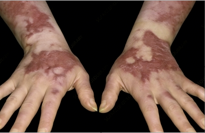 成都惠好安康烧伤康复故事：掌心重燃：一位化学教师的双手涅槃记