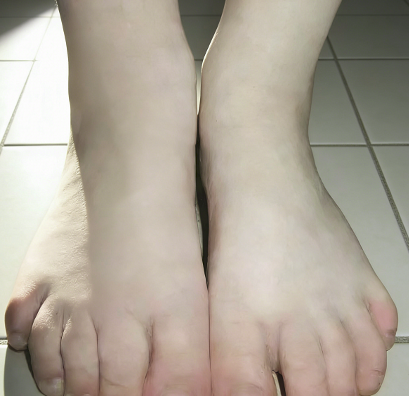 成都惠好安康烧伤康复故事：改写“铁律”：8岁男孩如何用康复对抗医学预判