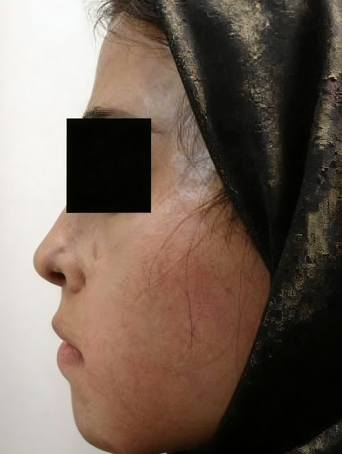 成都惠好安康烧伤康复故事：从毁容到重生：一个新疆女孩在成都的300天