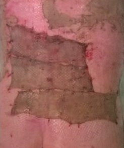 成都惠好安康烧伤康复故事：蝴蝶背上的花开：一个4岁女孩的烧伤康复之路