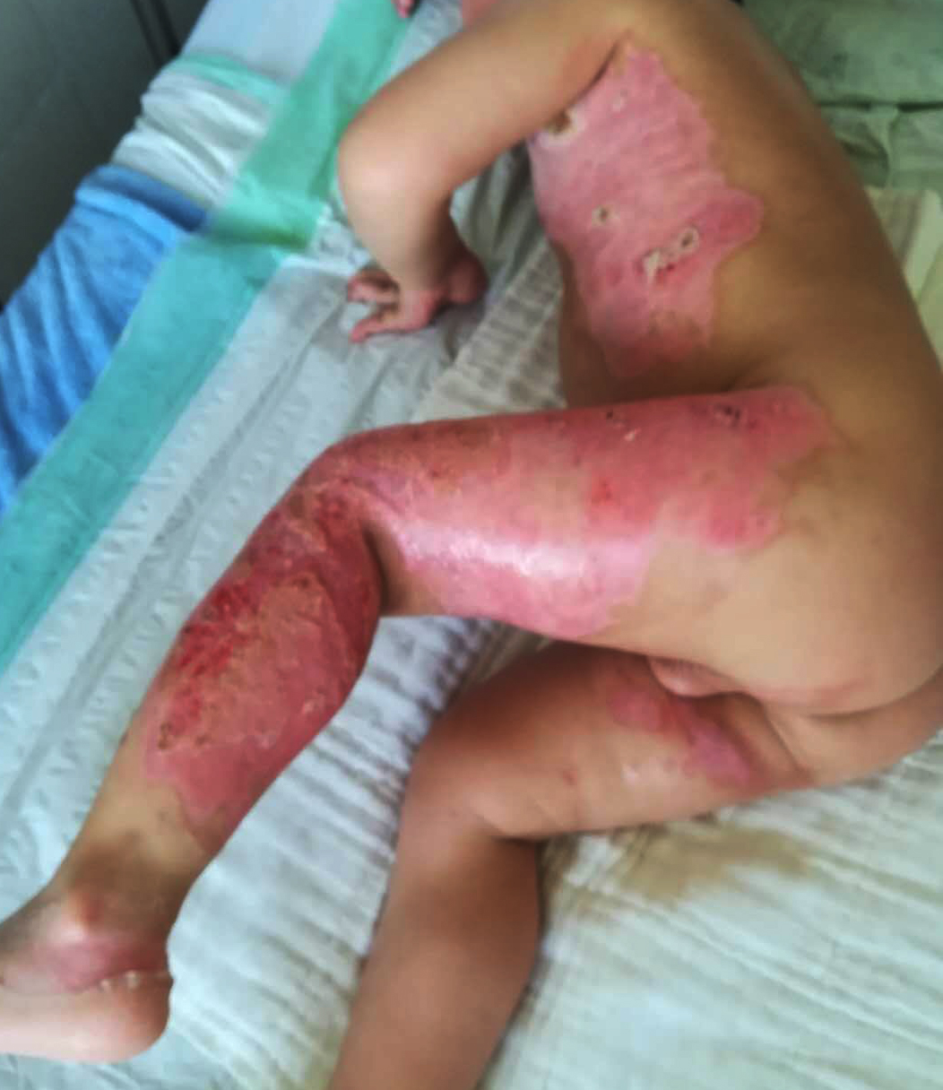 成都惠好安康烧伤康复故事：西安男孩的浴火重生：60%烧伤到奔跑如风的450天奇迹