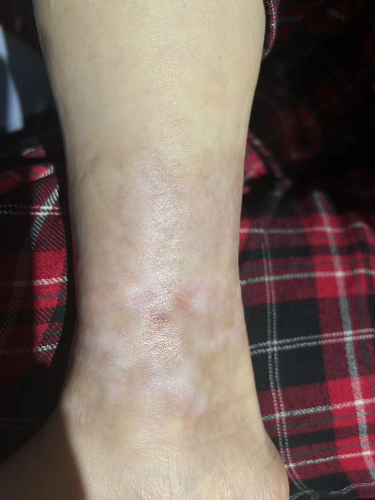 成都惠好安康烧伤康复故事： 抉择与新生：一位上海高管的跨城康复之旅——当专业遇见温度