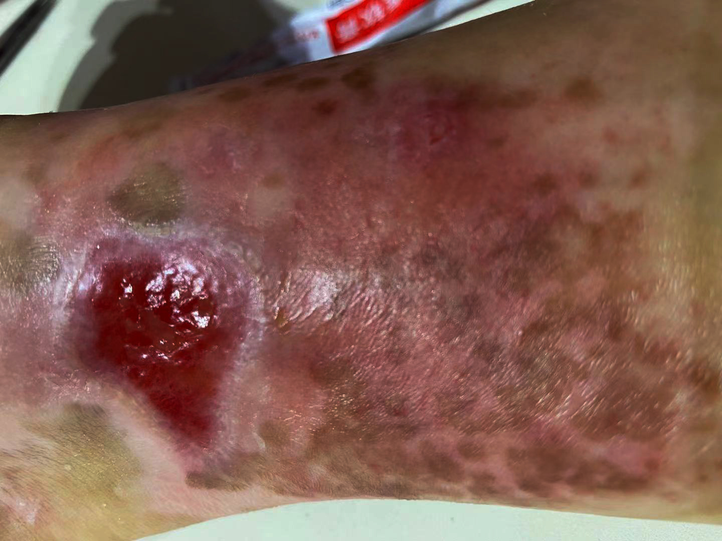 成都惠好安康烧伤康复故事： 抉择与新生：一位上海高管的跨城康复之旅——当专业遇见温度