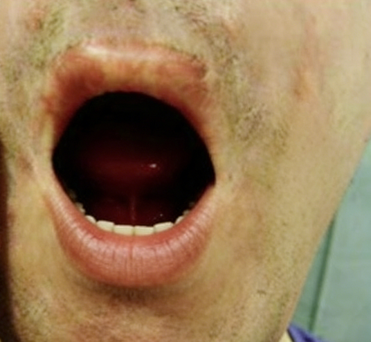 成都惠好安康烧伤康复故事：从紧闭到绽放：3D定制压力面罩与动态扩口器如何为烧伤小口症开启新生之门