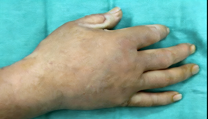 成都惠好安康烧伤康复故事：黄金72小时：一位川菜大厨的“完美救援”