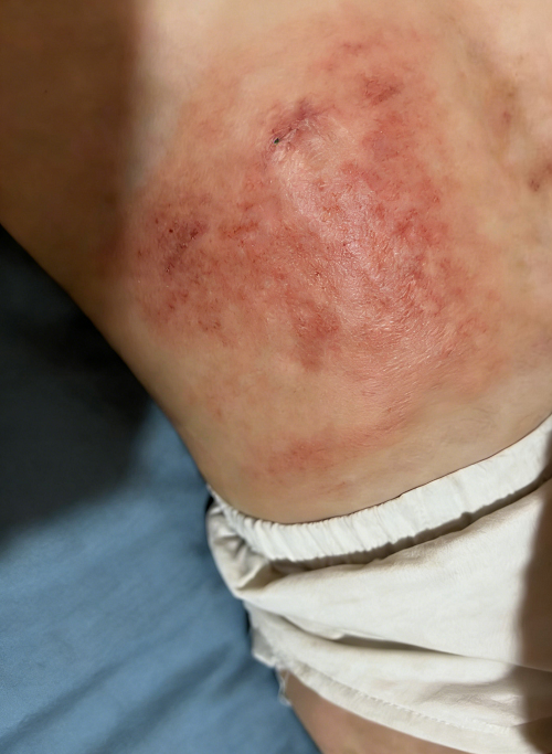 成都惠好安康烧伤康复故事：被烫伤的童年，被治愈的微笑：贵阳2岁宝宝的腹部疤痕康复之路