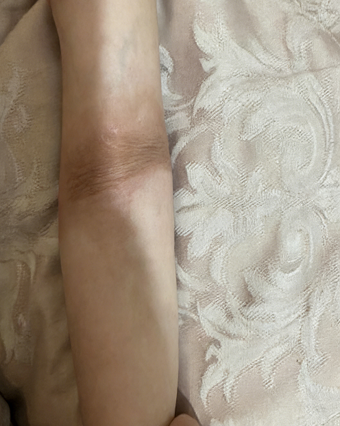 成都惠好安康烧伤康复故事：被“锁住”的小胳膊——3D定制矫形器如何让烧伤宝宝重新拥抱世界