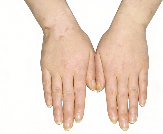 成都惠好安康烧伤康复故事：掌心重燃：一位化学教师的双手涅槃记