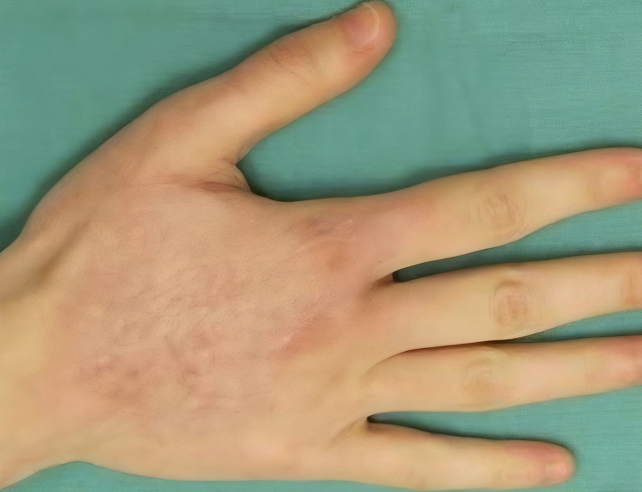 成都惠好安康烧伤康复故事：外科医生的手伤笔记：当救治者成为被救治者