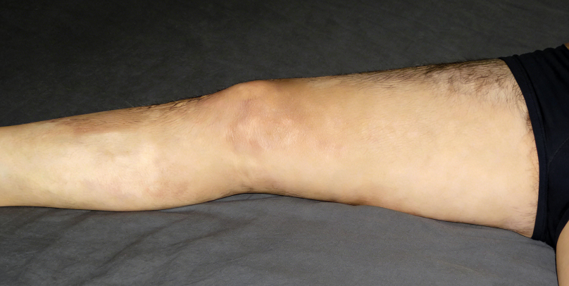 成都惠好安康烧伤康复故事：重返球场：一位成都父亲的烧伤康复之路