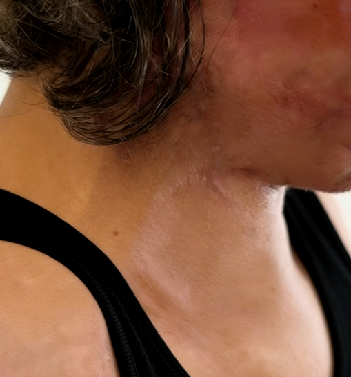 破茧重生，重启美好——成都惠好安康烧伤康复珍女士烧伤康复纪实