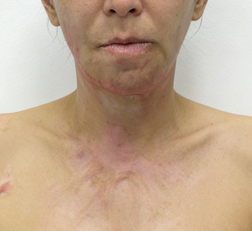 浴火重生，笑容如初——成都惠好安康烧伤康复苘女士康复纪实