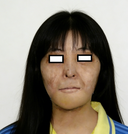 成都惠好安康烧伤康复故事：两次手术的教训：一位面部烧伤求美者的康复觉醒之路