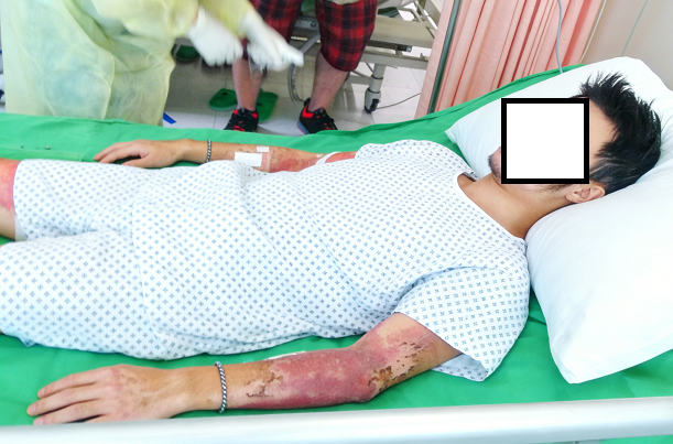 成都惠好安康烧伤康复故事：行走在烈焰之上：我的40%烧伤与三年复健路