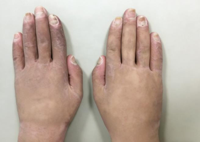 成都惠好安康烧伤康复故事：手的重生：一个34岁男人的1400个日与夜