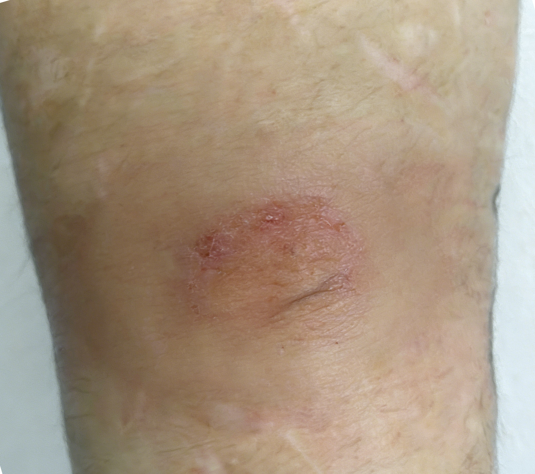 成都惠好安康烧伤康复案例故事： 那只被化学灼伤的手臂，终于能恢复如初了