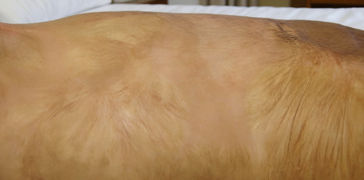 成都惠好安康烧伤康复故事：40岁那年，他终于敢脱掉衣服洗澡了