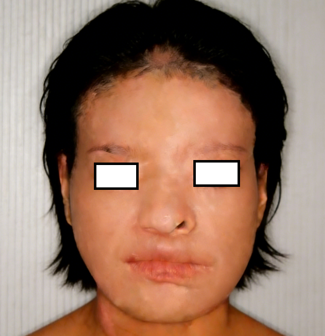 成都惠好安康烧伤康复故事：浴火芳华：一位成都女性的面容涅槃记