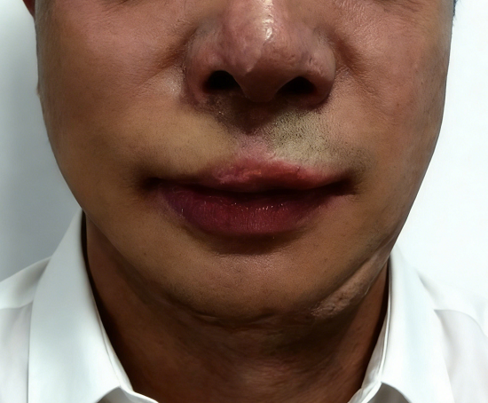 成都惠好安康烧伤康复故事：疤痕不会自己消失，但他花了2年学会了这件事