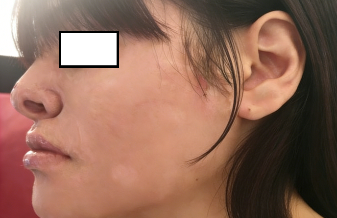 成都惠好安康烧伤康复故事：镜中人：一个平面模特的1.5年面庞重生记