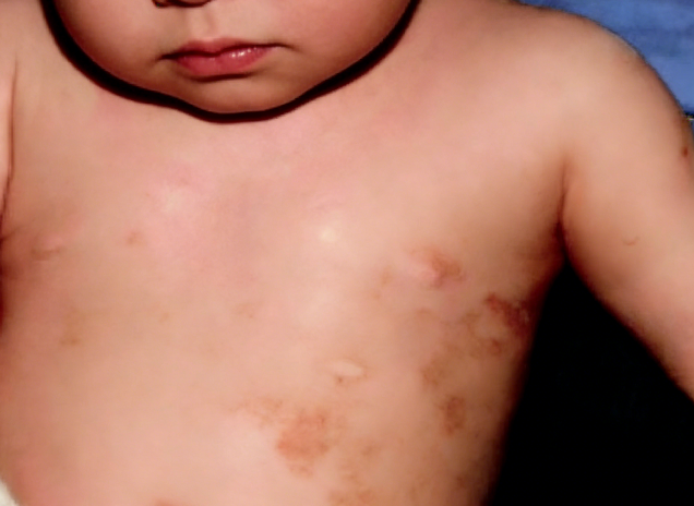 成都惠好安康烧伤康复故事：小乐乐的疤痕褪色记——从绝望到重生的545天