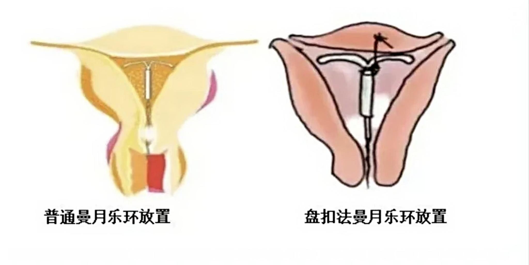 曼月乐总掉、总移位？蚌埠二院妇科“盘扣固定术”，让环稳稳“安家”！