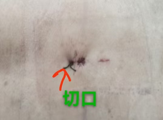 青年启健康，中年稳生活，老年享安康——市二院骨三科微创技术点亮全年龄段腰椎患者新生活