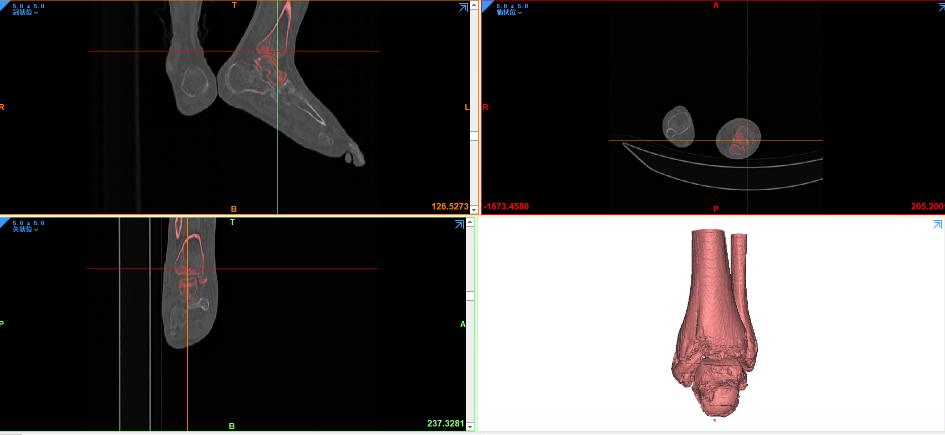 3D打印术前规划|蚌埠二院骨三科：踝关节骨折精准“预演”，手术更安全高效