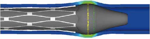 心血管器械（支架、线圈和心脏瓣膜设计）