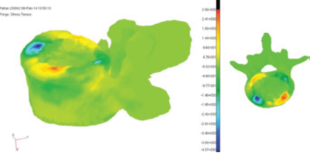 MSC Nastran助力Infosy公司精确评估骨折风险