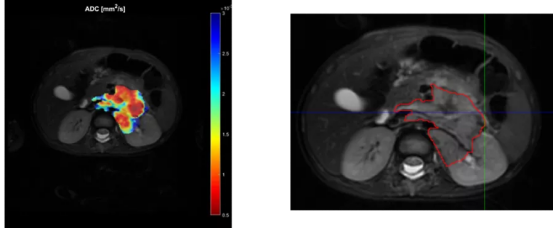 神经母细胞瘤的核磁共振成像（MRI）扫描