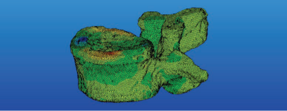 MSC Nastran助力Infosy公司精确评估骨折风险