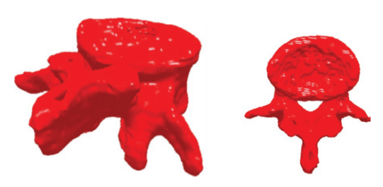 MSC Nastran助力Infosy公司精确评估骨折风险