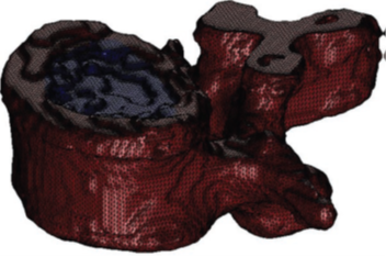 MSC Nastran助力Infosy公司精确评估骨折风险