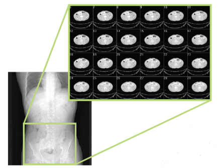 MSC Nastran助力Infosy公司精确评估骨折风险