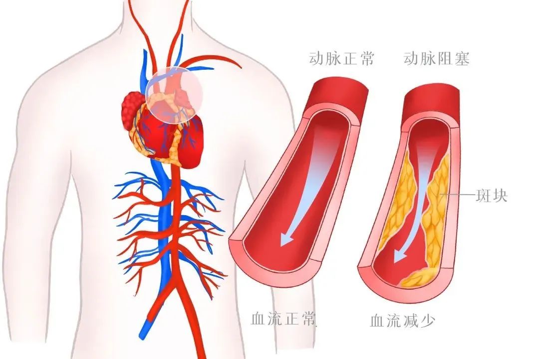 防治高血脂，从这4件事做起！降脂其实很简单