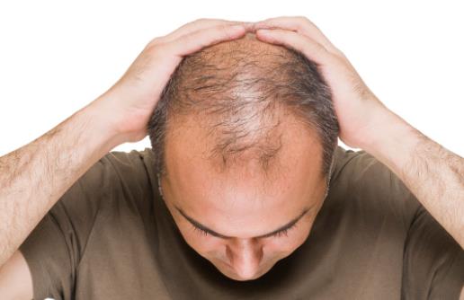 熬夜真的会秃头吗？快来救救你的头发！