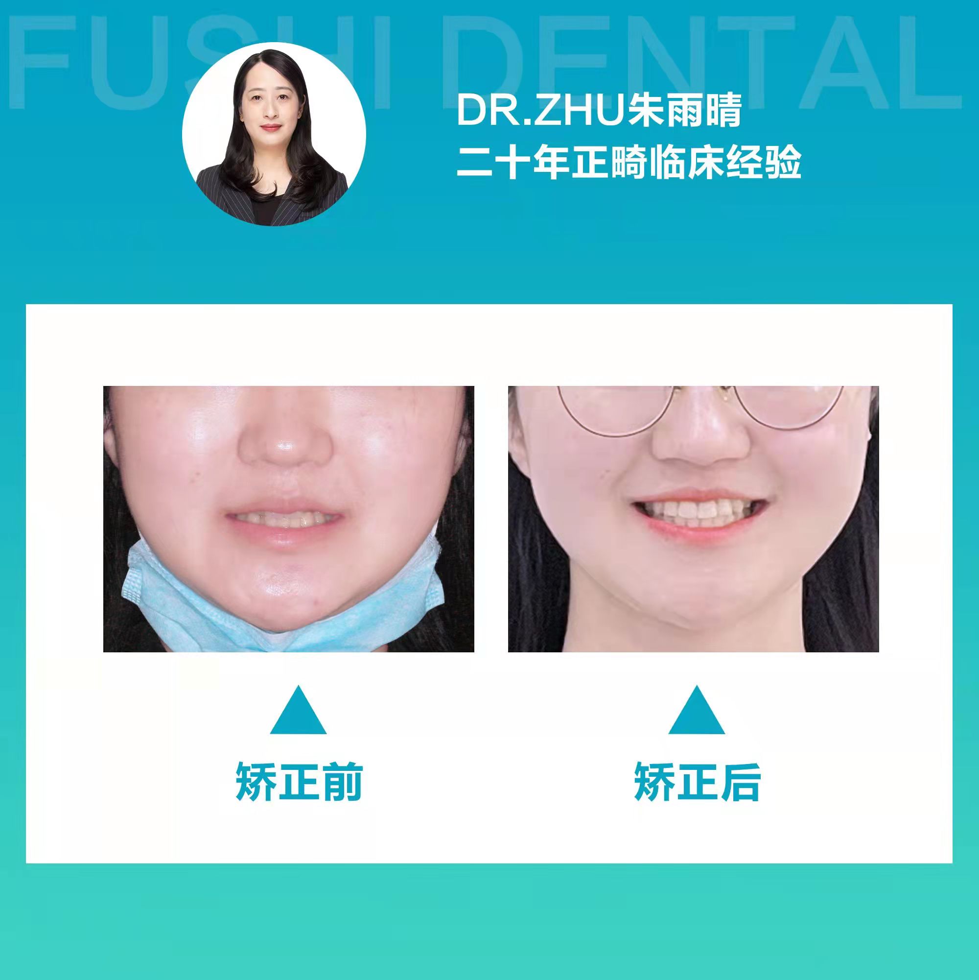 十四个月告别牙列不齐，笑口迎接未来人生—义乌傅氏口腔