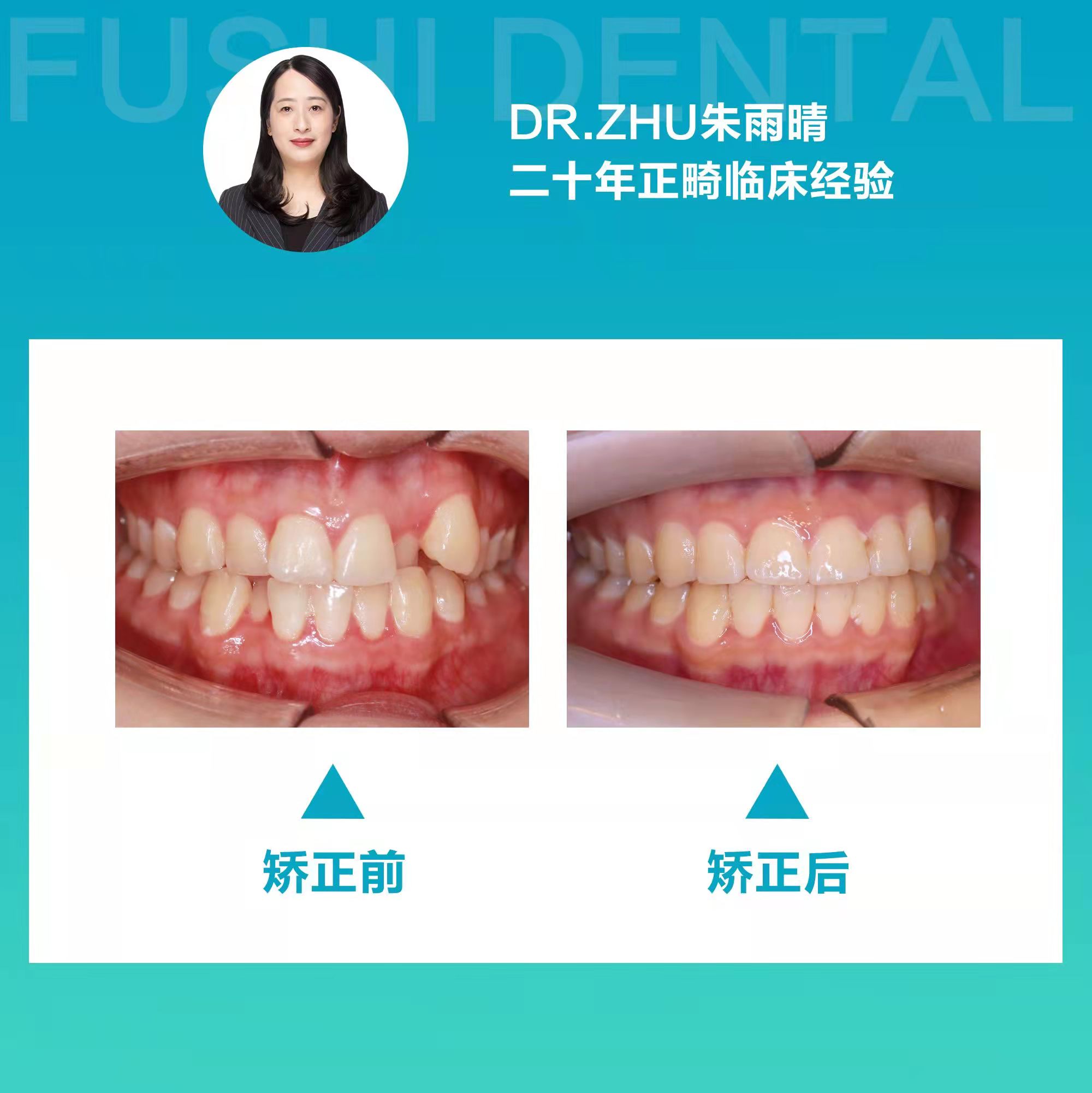 十四个月告别牙列不齐，笑口迎接未来人生—义乌傅氏口腔