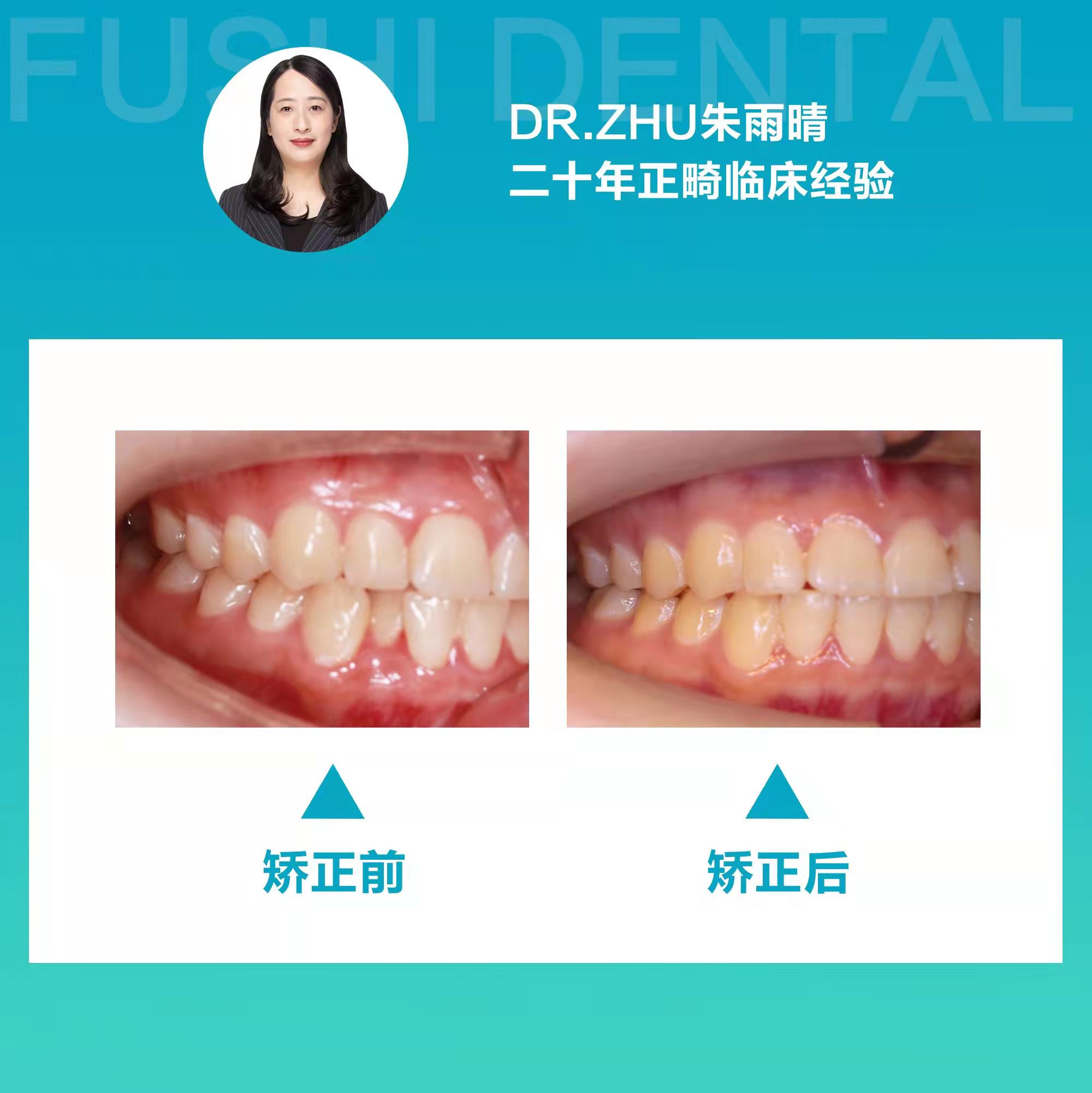 十四个月告别牙列不齐，笑口迎接未来人生—义乌傅氏口腔