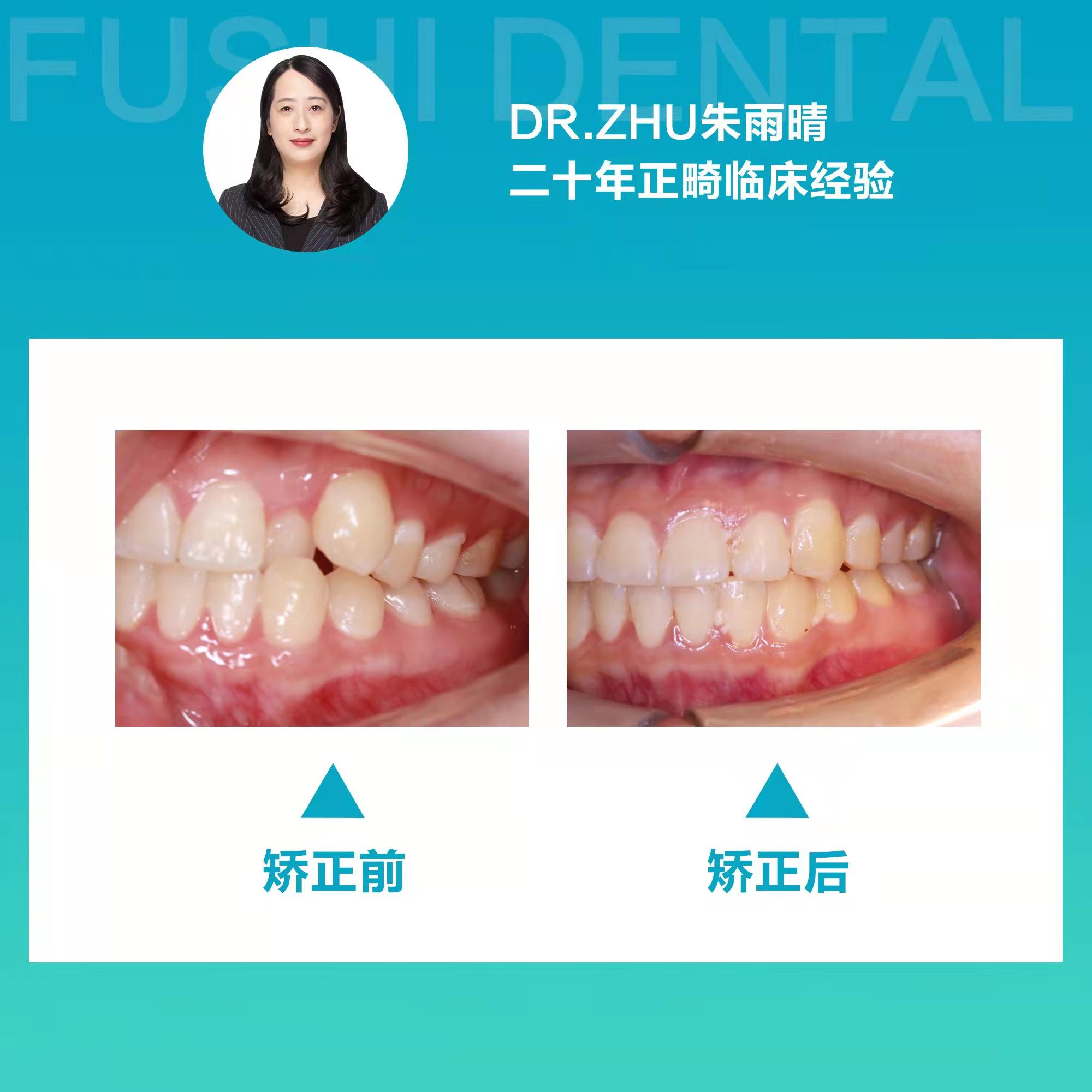 十四个月告别牙列不齐，笑口迎接未来人生—义乌傅氏口腔
