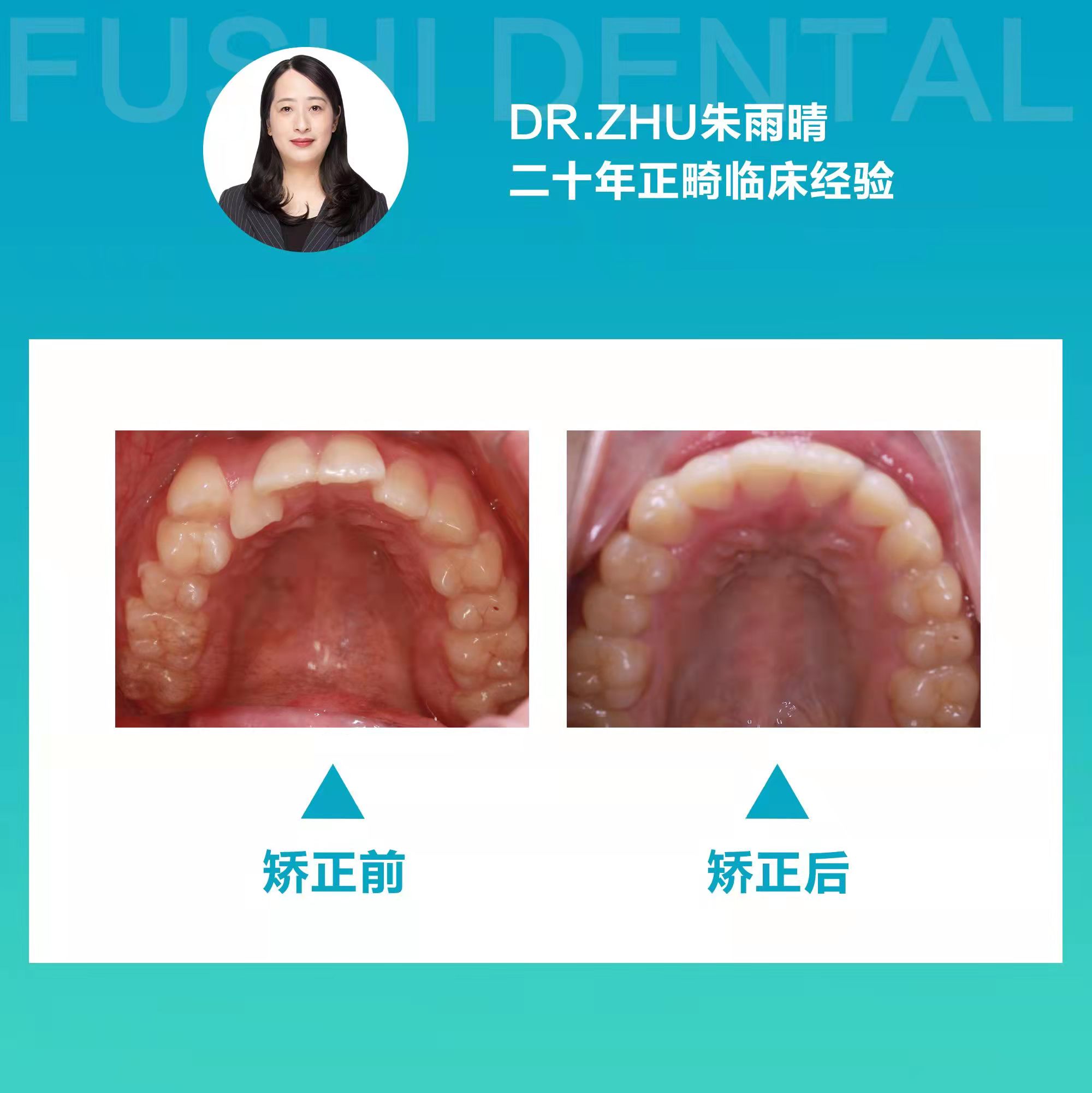十四个月告别牙列不齐，笑口迎接未来人生—义乌傅氏口腔