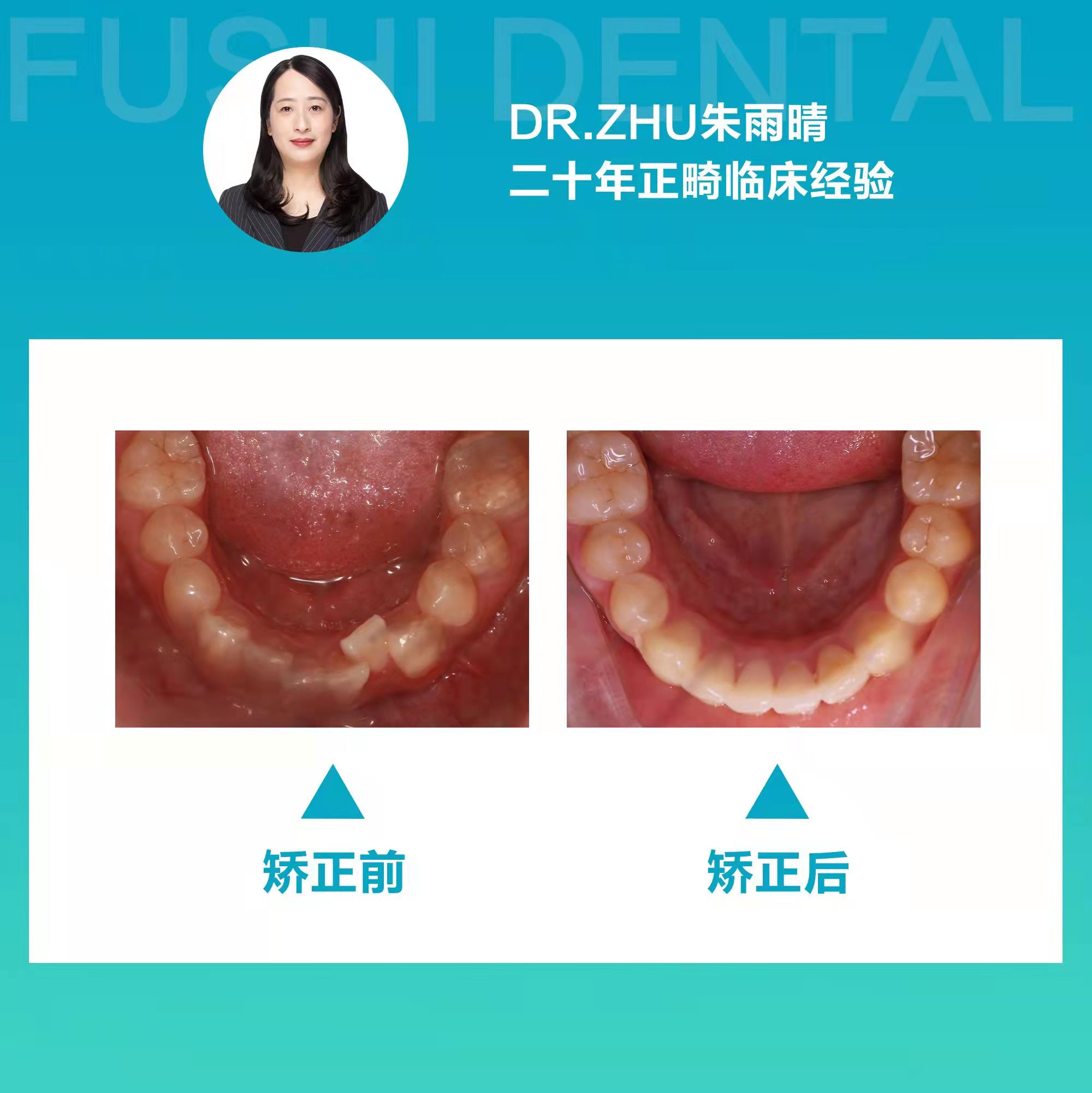 十四个月告别牙列不齐，笑口迎接未来人生—义乌傅氏口腔