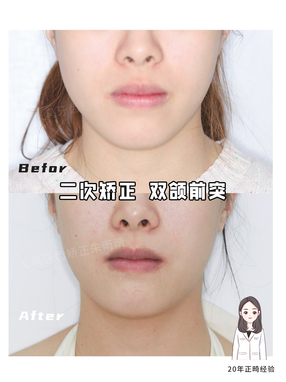 义乌傅氏口腔嘴凸二次矫正案例分享！