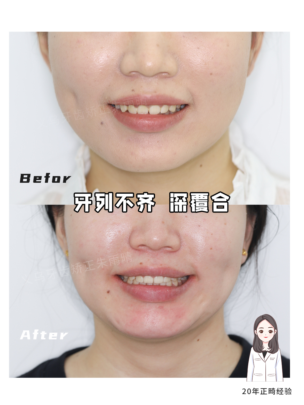 义乌傅氏口腔牙列不齐深覆合矫正案例分享！