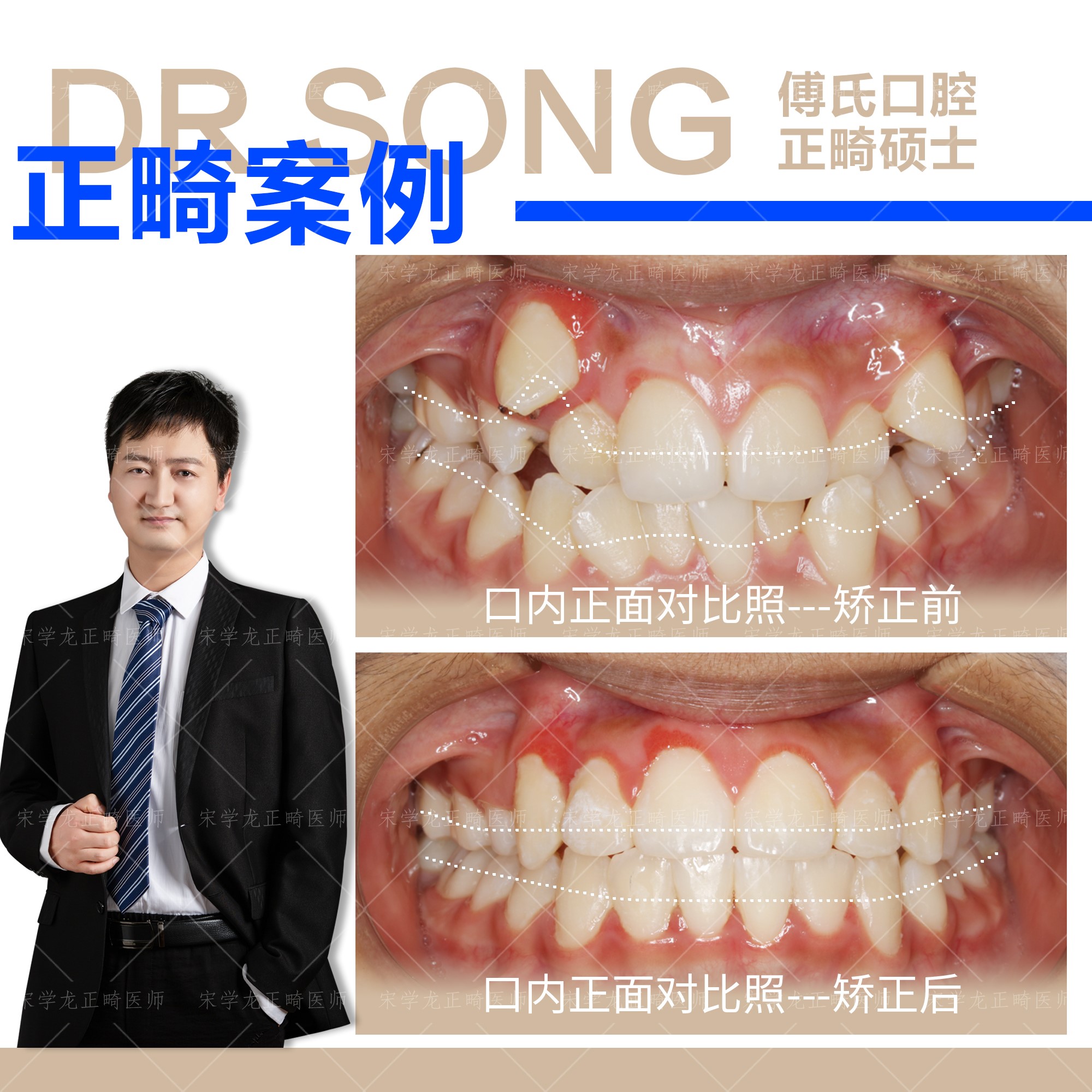 正畸案例